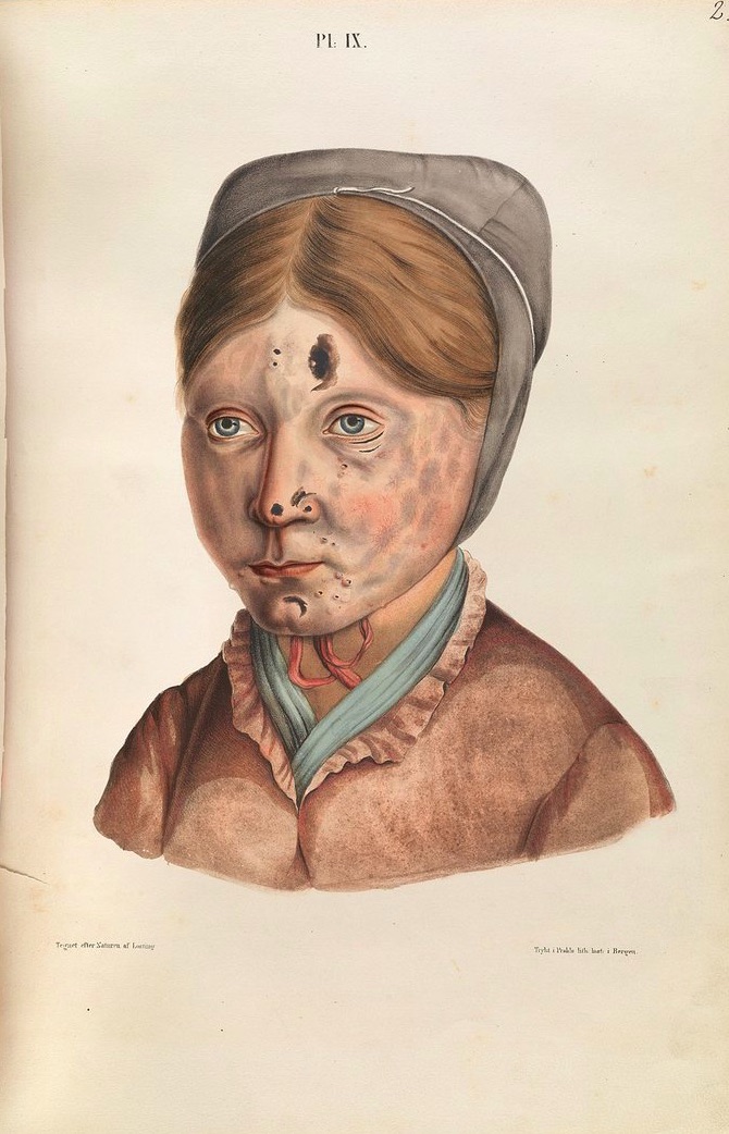 003diseaselep13g.jpg