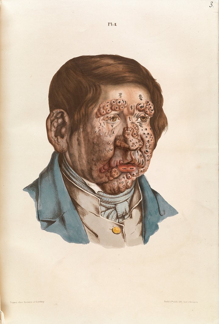 004diseaselepb13.jpg