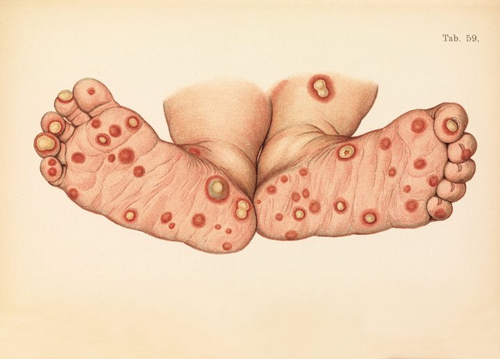 005diseasefeet.jpg