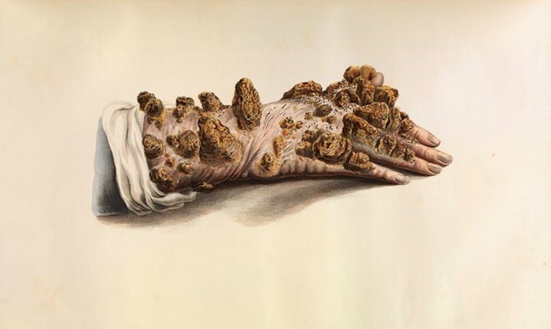 009diseaselep3.jpg