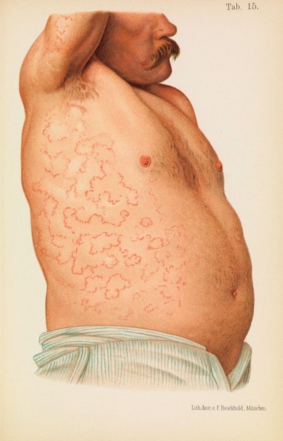010diseaseerythema.jpg