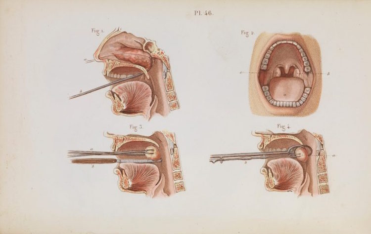 011surgeryillus.jpg