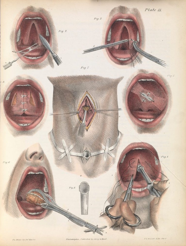 012surgeryillus.jpg