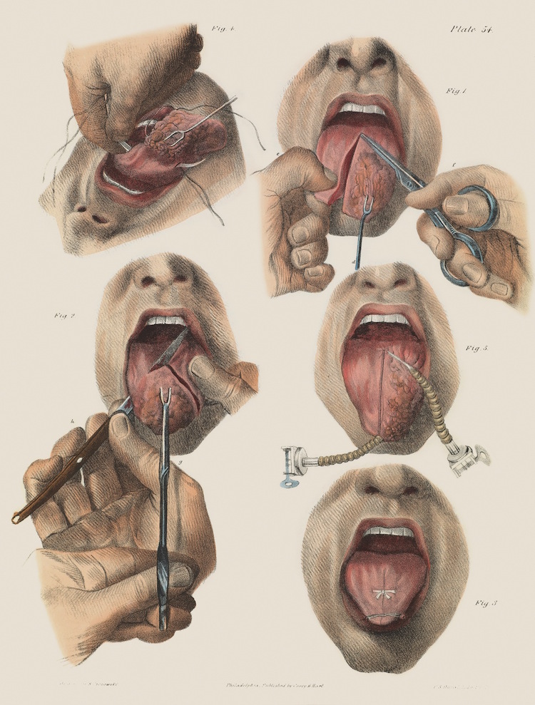 015surgeryillus.jpg