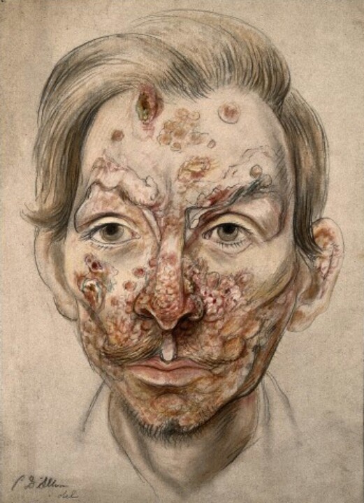 017diseasesyph57.jpg
