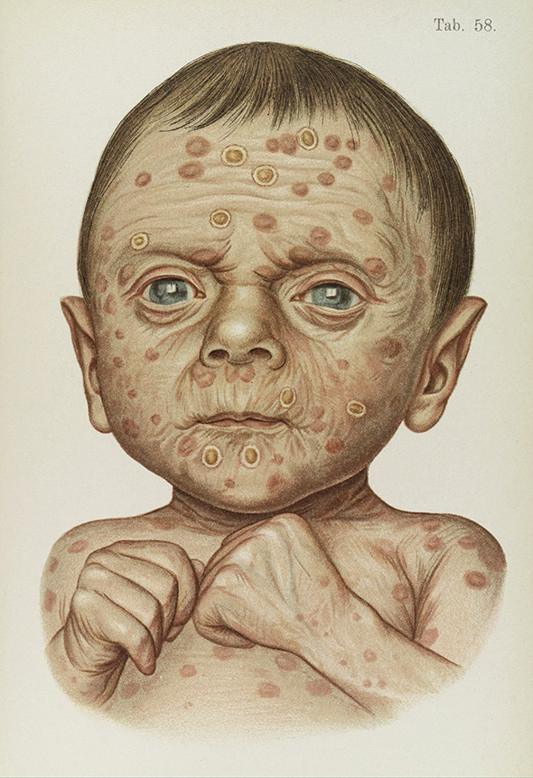 018diseaseheredsyp.jpg