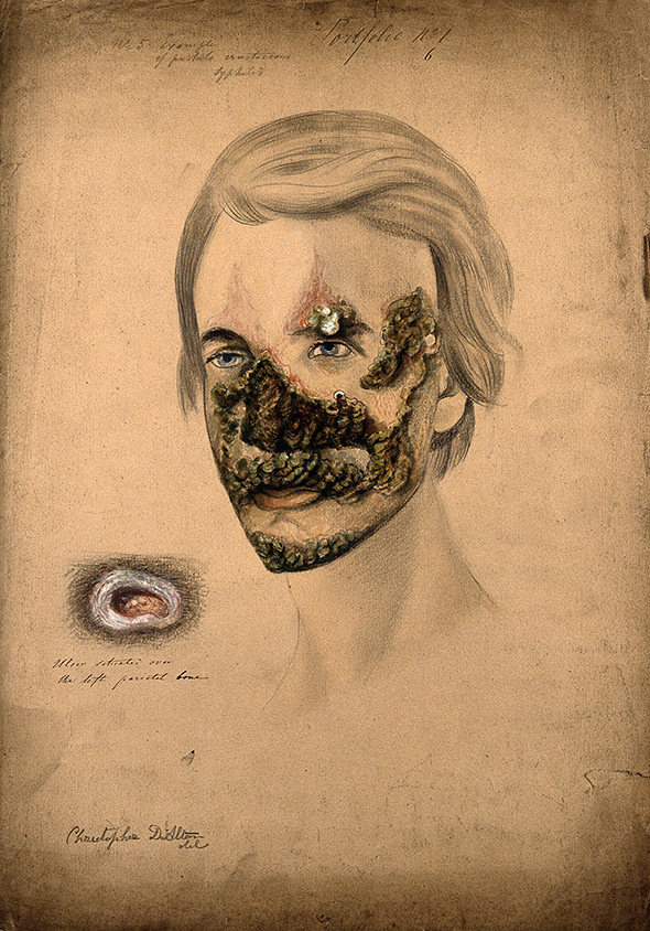 018diseasesyph.jpg