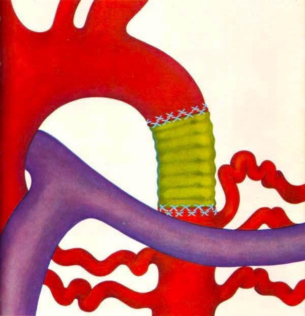 024La_chirurgie_des_malformations_congenitales_Osterwalder1