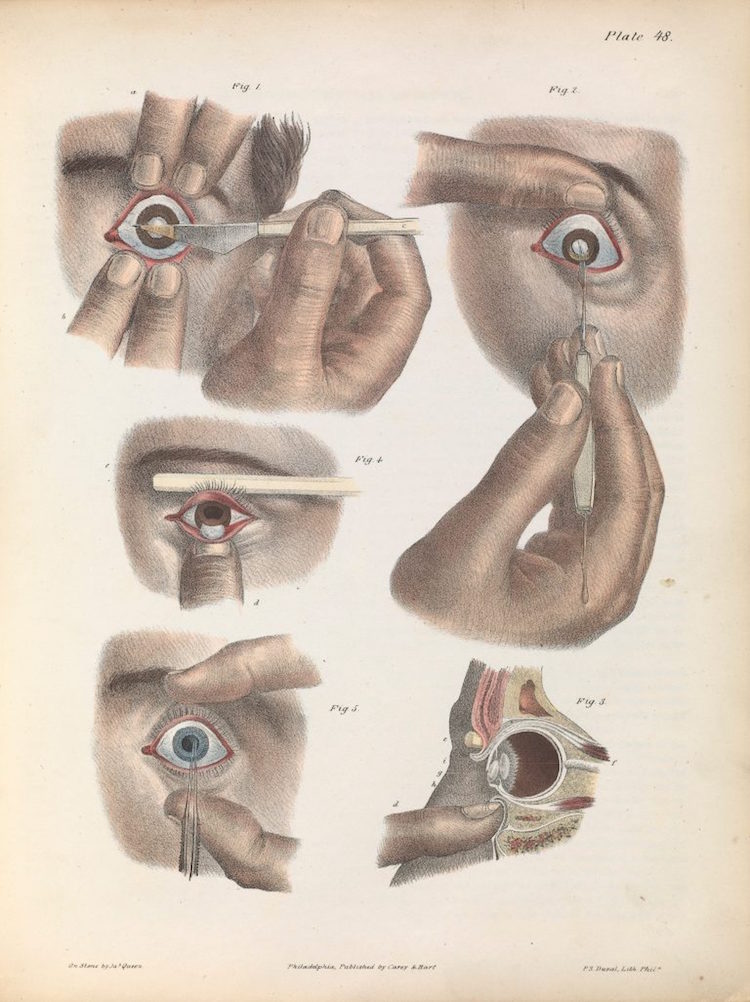 03surgeryillus.jpg